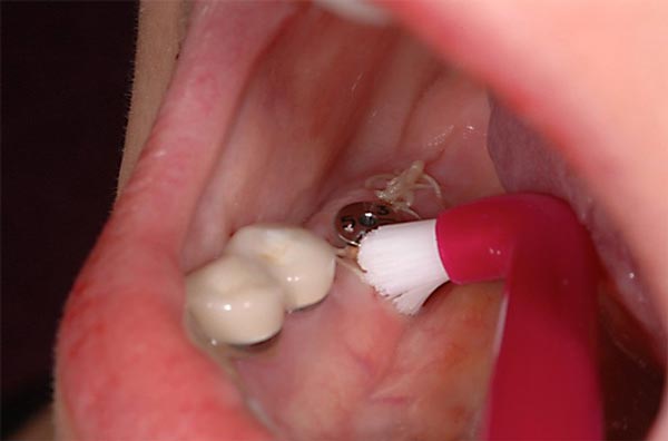 مراقبت صحیح از ایمپلنت های دندانی