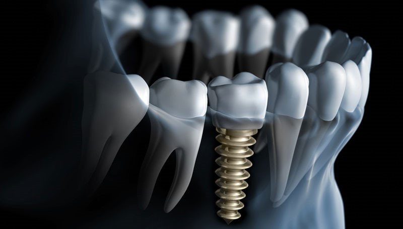 عمل کاشت ایمپلنت دندان