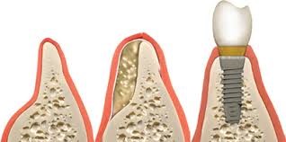 پیوند استخوان برای کاشت ایمپلنت دندان