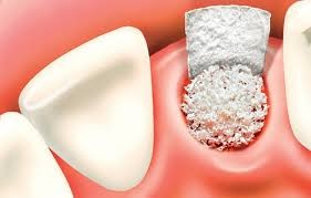 جراحی های بازسازی استخوان پیش از کاشت ایمپلنت دندان