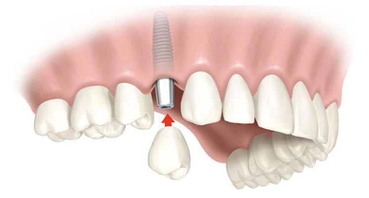 ایمپلنت دندان مصنوعی و بریج