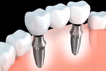 ایمپلنت دندان مصنوعی و بریج