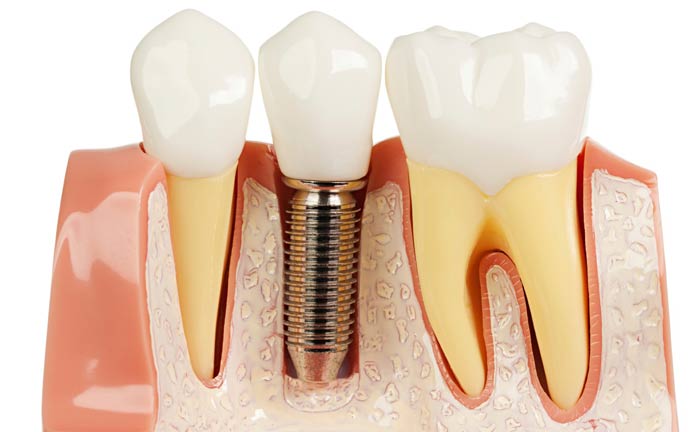 کاشت موفق ایمپلنت دندان در بلند مدت