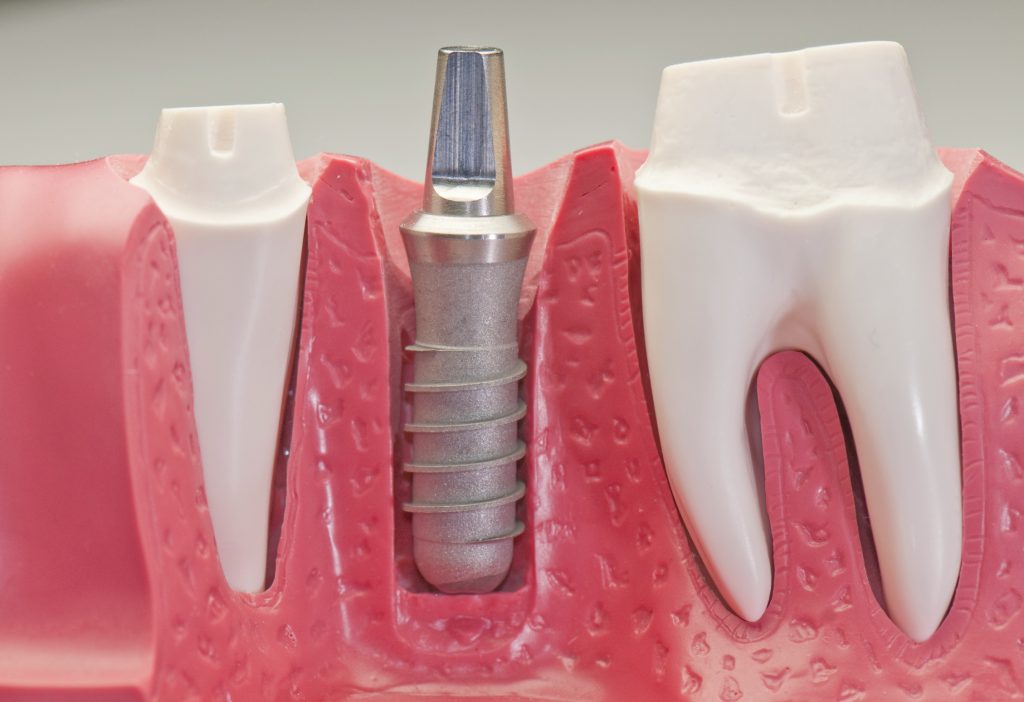 کاشت موفق ایمپلنت دندان در بلند مدت