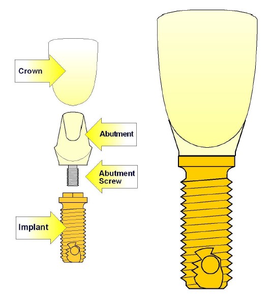 اجزاء ایمپلنت‌های دندانی
