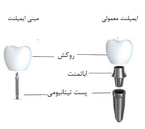 مینی ایمپلنت‌ دندانی