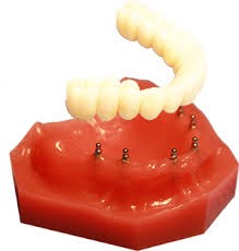 مینی ایمپلنت‌ دندانی