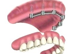 پروتزهای دندانی متحرک بر پایه ی ایمپلنت