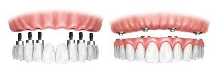 پروتزهای دندانی متحرک بر پایه ی ایمپلنت