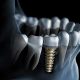 ایمپلنت دندان با فناوری نانوتکنولوژی