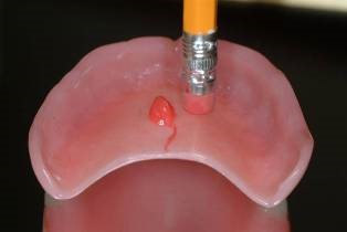 چسب های پروتزهای مصنوعی دندانی