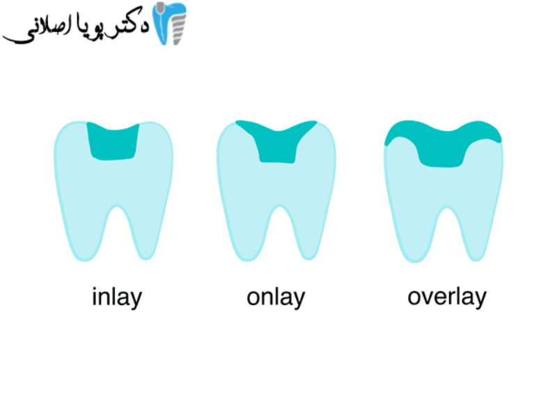 اینله و آنله دندان چیست؟