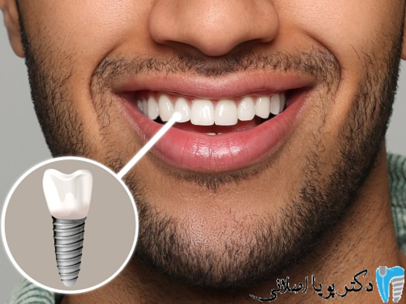 ایمپلنت دندانی برای بیماران کلیوی