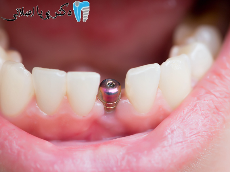 عوارض ایمپلنت دندانی برای بیماران کلیوی