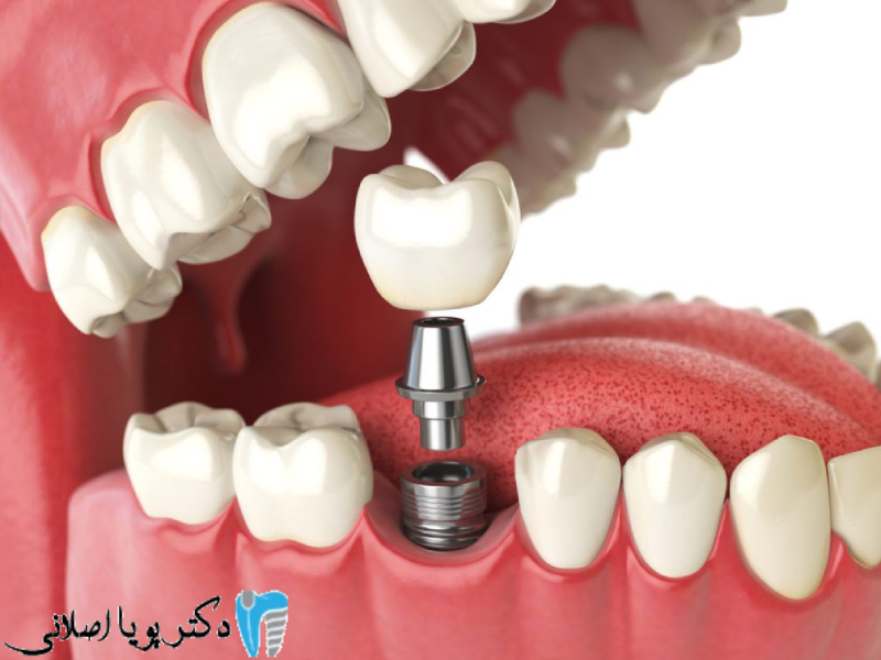 فواید ایمپلنت مگاژن